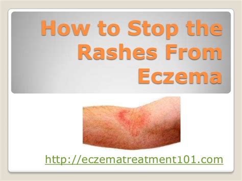 How To Stop The Rashes From Eczema