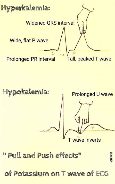 Medicowesome Ecg Changes Seen In Hyperkalemia And