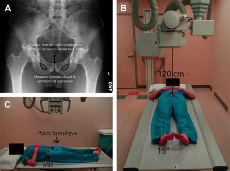 A Ap View Of The Pelvis Which Allows Appropriate Hip Measurements