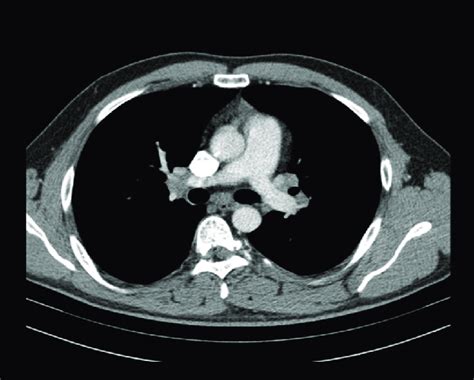 Ct Scan Showing Mediastinal Lymphadenopathy At The Time Of Diagnostic