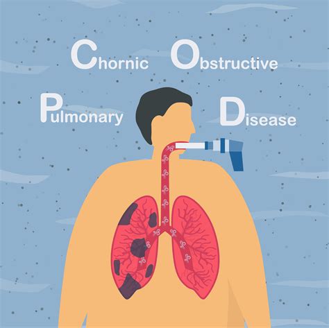 Dise O De Enfermedad Pulmonar Obstructiva Cr Nica Vector En Vecteezy