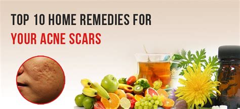 Top 10 Home Remedies For Acne Scars How To Remove Acne From Face