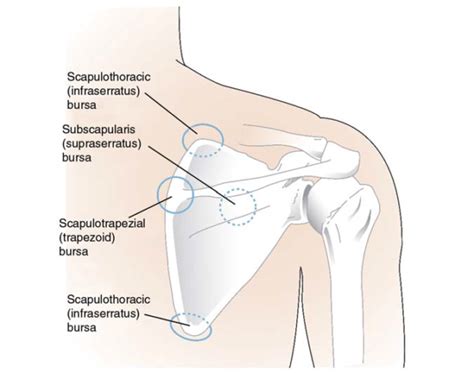 Snapping Scapula Scapulothoracic Bursitis Colorado