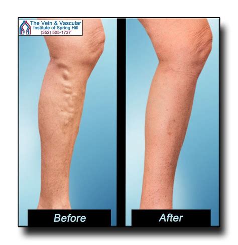 Varicose Veins Before And After Pictures Vein And Vascular Institute