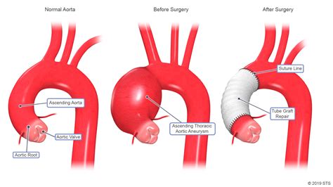 Thoracic Aortic Aneurysm Newport Cardiac Thoracic Surgery