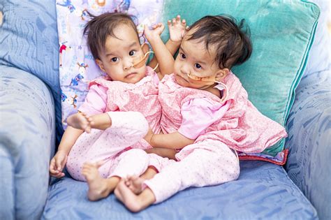 Conjoined Twin Baby Girls Separated After Major Six Hour Surgery News