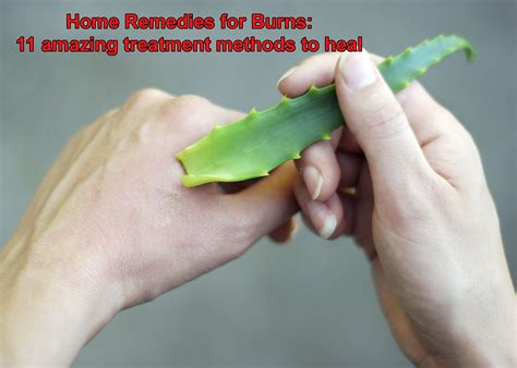 Home Remedies For Burns 11 Amazing Treatment Methods To Heal Çok Bilenler