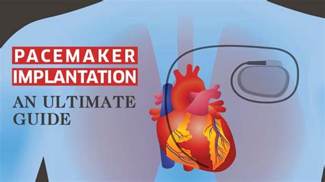 Pacemaker Implantation Surgery In India Guide Cost Aftercare And Risks