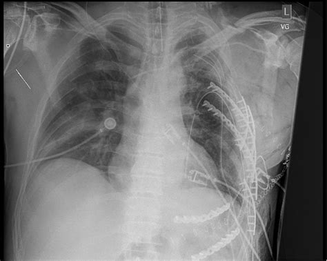 Rib Fixation Who What When Trauma Surgery And Acute Care Open