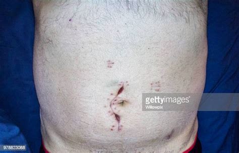 Appendicitis Surgery Photos And Premium High Res Pictures Getty Images