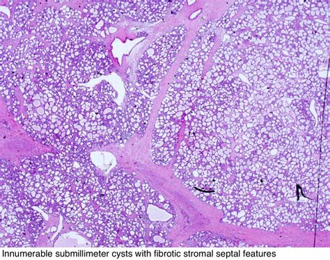 Pathology Outlines Serous Cystadenoma