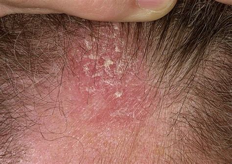 Causes Of Scalp Dermatitis How To Treat It Purc Organics