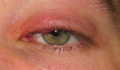 Stye Eye Causes Symptoms Pictures Treatment Prevention Healthmd