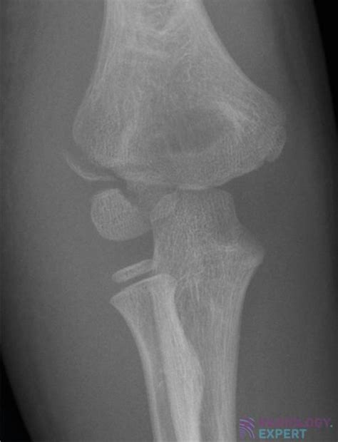 Milch Classification Of Lateral Humeral Condyle Fractures Radiology