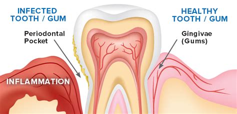Just now i noticed the gums around his upper 4 are very red and inflamed. Understanding Gum Disease - Types, Symptoms & Treatments