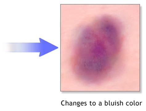 How To Help Bruises Heal Examples And Forms