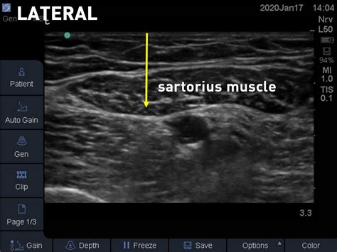 Saphenous Nerve Block Ultrasound