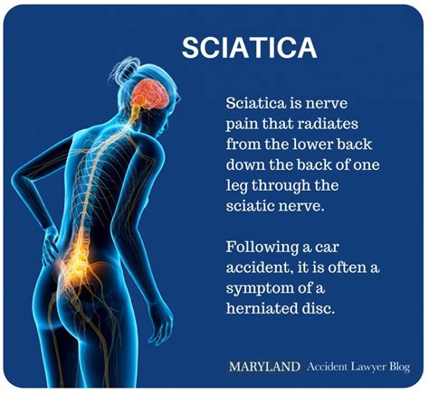 Sciatica Pain After A Car Accident — Maryland Accident Lawyer Blog