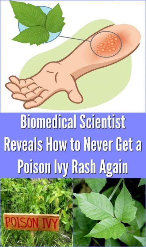 Biomedical Scientist Reveals How To Never Get A Poison Ivy Rash Again