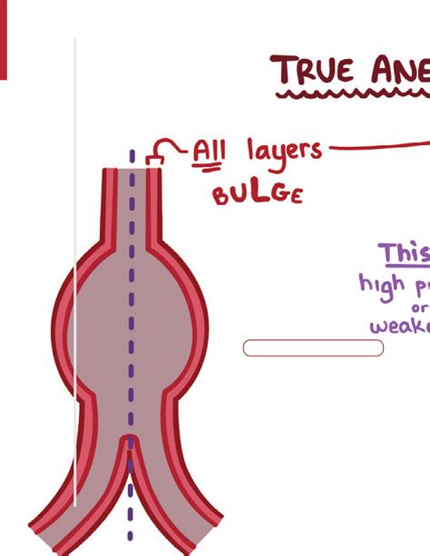 Aneurysms And Dissection Notes Diagrams Illustrations Osmosis