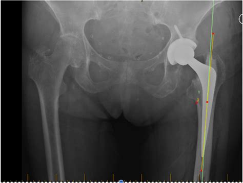 The Bikini Incision Anterior Cemented Total Hip Arthroplasty Assessment Of Radiological And