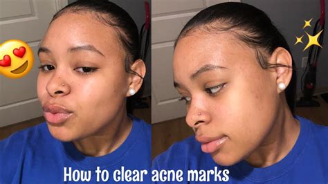 We did not find results for: How To Get Clear Skin & Rid Of Acne Scars - YouTube