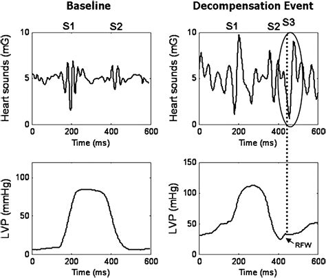 S3 Amplitude Measured Chronically With An Implanted Icd Sensor Is