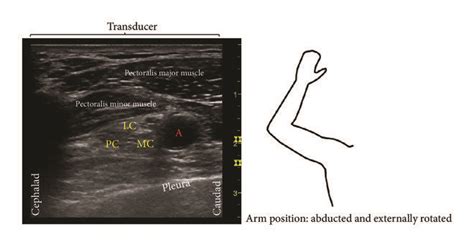 Follow Up Ultrasound Evaluation Of The Infraclavicular Brachial Plexus
