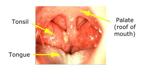 His skin is very hot, dry and red. Swollen Tonsils - Symptoms, Causes, Pictures, Treatment ...