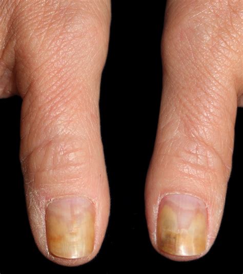 Fungal Fingernail Infection