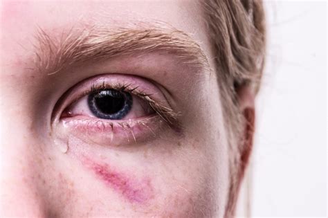 Should You Call 911 A Guide To Common Eye Injuries And How To Treat