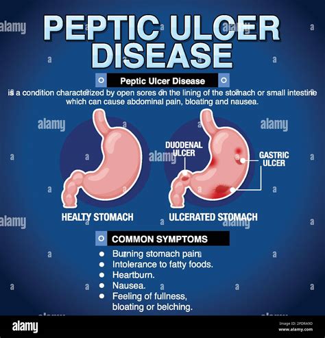 Peptic Ulcer Disease Explained Infographic Illustration Stock Vector