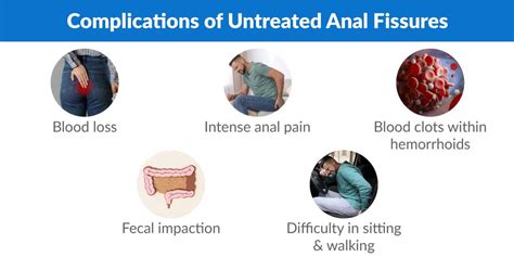 Which Doctor Should I Consult For Anal Fissure Treatment Piles Doctor
