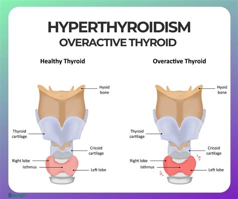 Overactive Thyroid Hyperthyroidism Symptoms Causes Risk Groups And Treatment Ecosh