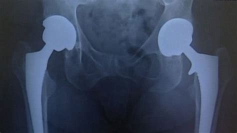 Mhra Metal Hip Implant Patients Need Life Long Checks Bbc News