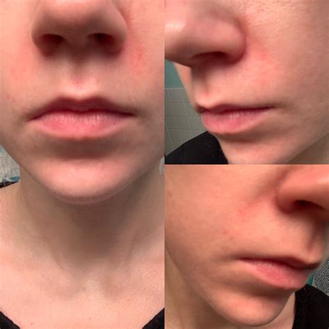 Skin Concerns Persistent Redness Around My Nose Routine And More Info