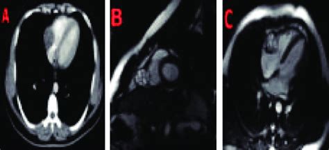 Case Of Cardiac Cyst Hydatid A Computed Tomographic Image B