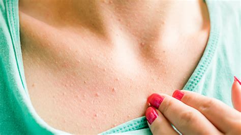 Heres Whats Really Causing The Acne On Your Chest