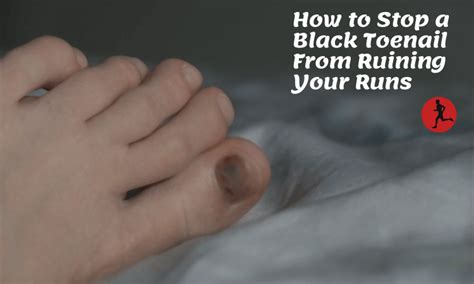 How To Prevent And Treat A Black Toenail From Ruining Your Runs Long