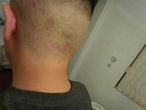 39 Awesome Rash On Neck After Haircut Haircut Trends
