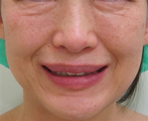 50代女性 目の下のクマ治療＋顔のシワ・たるみ治療＋くすみ治療 1年2か月後の経過