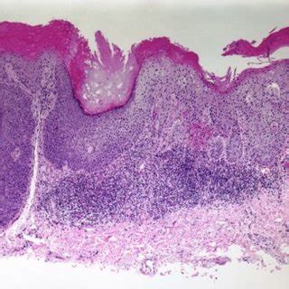 PDF Perianal Squamous Cell Carcinoma In Situ A Report Of Two Human Papilloma Virus Negative Cases