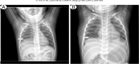 Figure 2 From Congenital Diaphragmatic Eventration In Children 12