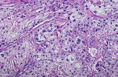Micrograph Of Squamous Cell Carcinoma Of The Head And Neck Stock Photo