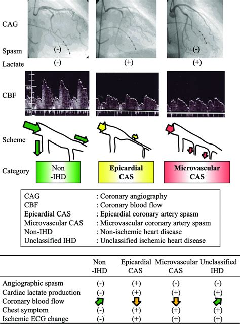 Microvascular Coronary Artery Spasm Presents Distinctive Clinical