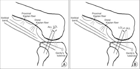 Anatomical Configuration Of The Anterolateral Ligament All A