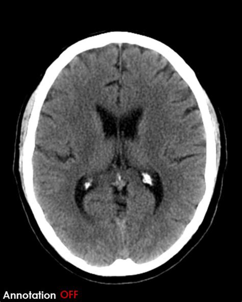 Ct Brain Scroll Image Gallery Normal Ventricles