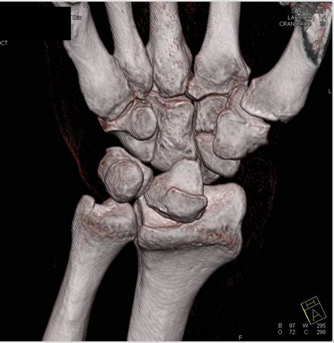 3D Imaging of the Wrist with Lunate Dislocation - Musculoskeletal Case