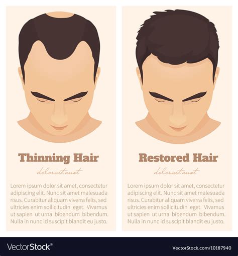 Male Pattern Baldness Design Template Royalty Free Vector