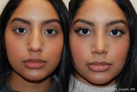 Eric M Joseph Md Rhinoplasty Before After Hump Removal And Tip Rotation